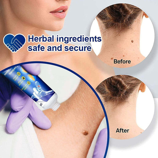 Wart Remover Ointment -  For Skin Tag & Wart Removal