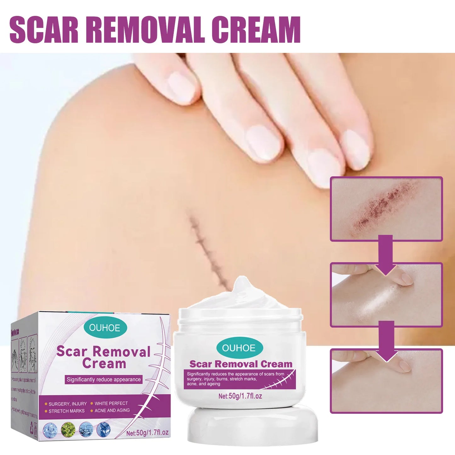 Scar & Stretch Marks Removal Cream