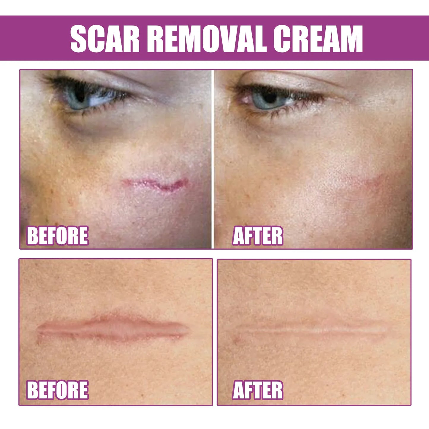 Scar & Stretch Marks Removal Cream