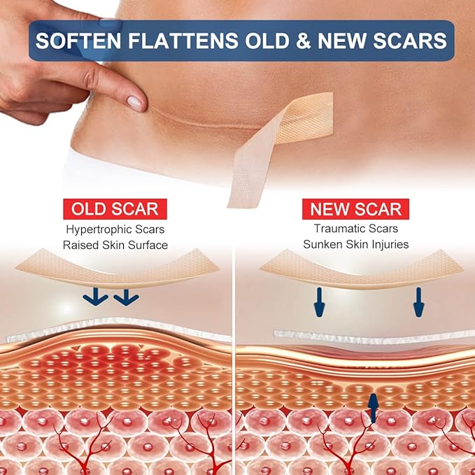 1.5M Silicone Scar Sheets/Tape Roll/Strips, Reusable, Professional for C-Section, Surgery, Burn, Keloid, Acne etc