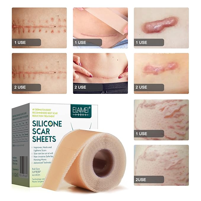 1.5M Silicone Scar Sheets/Tape Roll/Strips, Reusable, Professional for C-Section, Surgery, Burn, Keloid, Acne etc